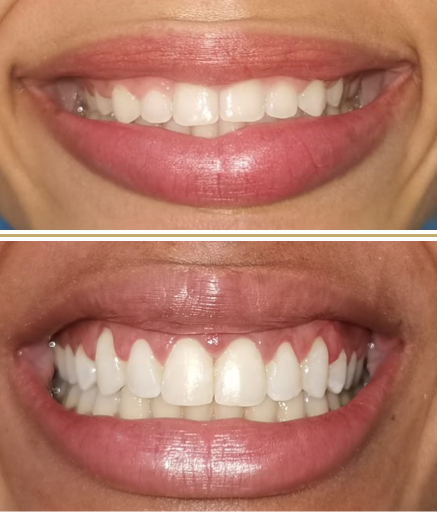 Transformação dental - Plástica gengival e clareamento