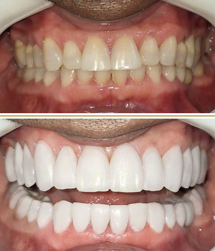 Transformação dental - Lentes de contato dentais