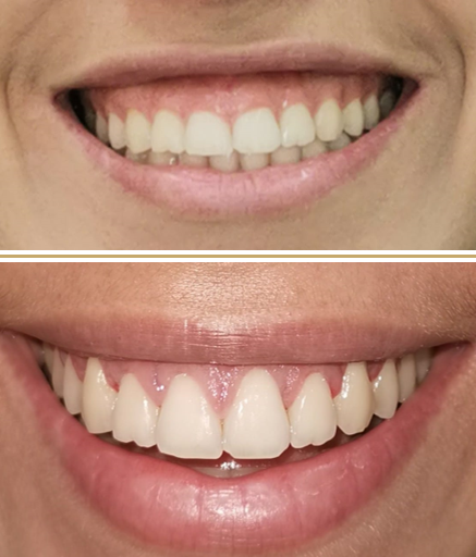 Transformação dental - Plástica gengival e clareamento